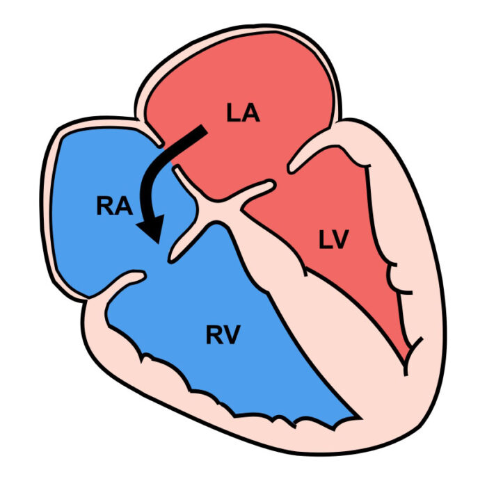 Erişkin Konjenital Girişimler ASD