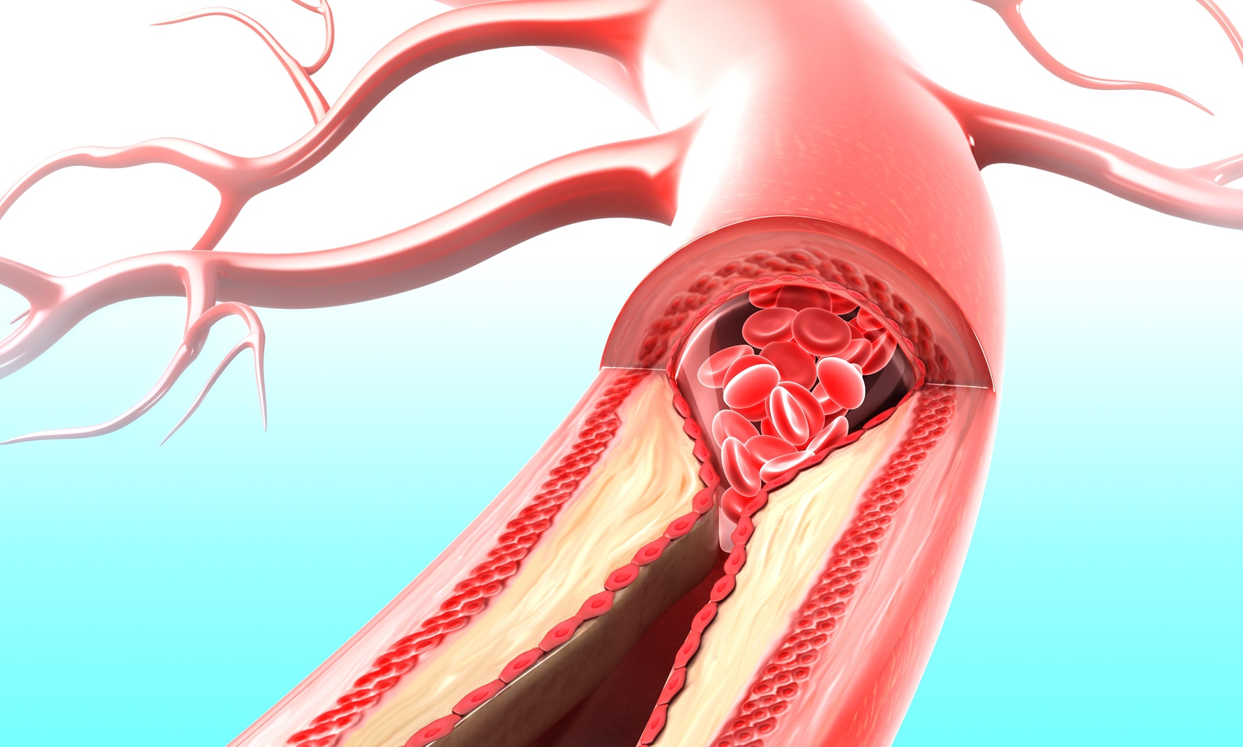periferik arter hastalığı nedir
