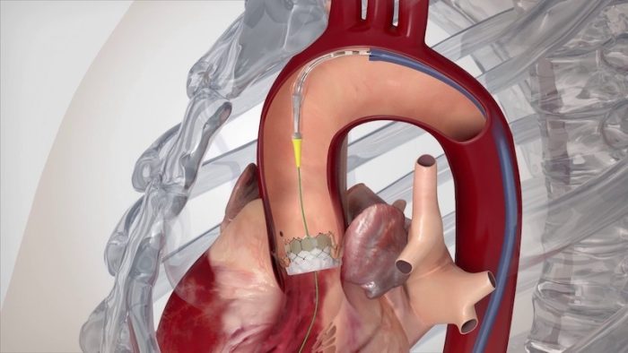Transkateter Aort Kapak İmplantasyonu (TAVI) Nedir? Nasıl Yapılır?
