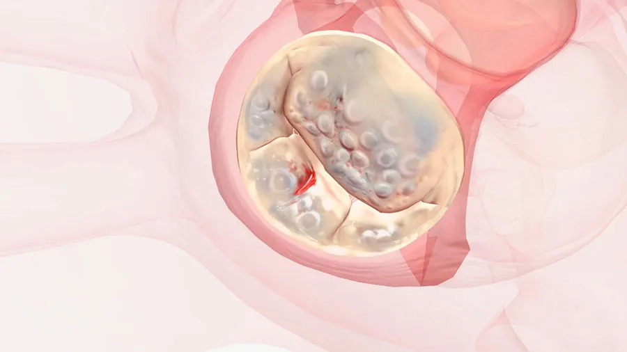 mitral kapak yetmezliğinde klips