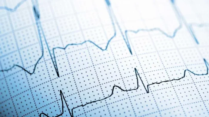 Aritmi (Ritim Bozukluğu) Nedir? Tanı ve Tedavi Seçenekleri