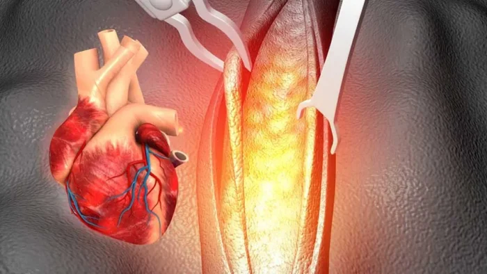 Stent ve Bypass Ameliyatı Arasındaki Farklar Nelerdir?