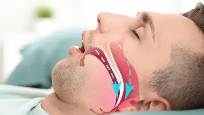 Uyku Apnesi ve Kalp Sağlığı Arasındaki Bağlantı