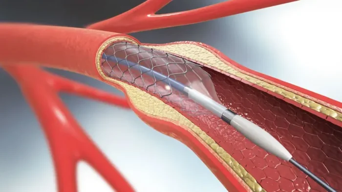 Stent Sonrası Yaşam: Ne Zaman Normal Hayata Dönerim?