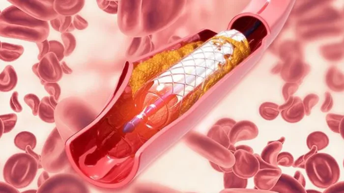 Anjiyo İlacı Böbreklere Zarar Verir mi?